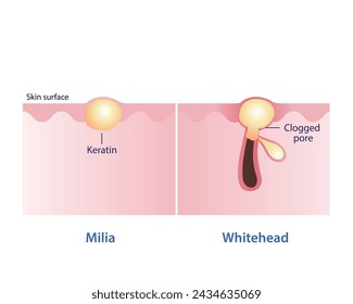 Comparison of Milia and Whitehead vector illustration isolated on white background. Milia, small white bump, trapped keratin. Whitehead, closed comedone, clogged pore. Skin care and beauty concept. 