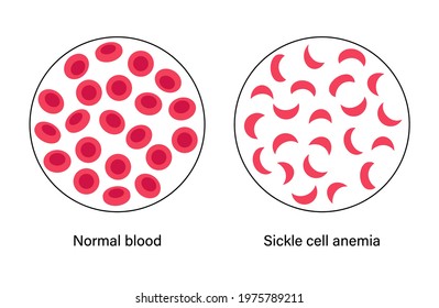 Comparison Normal Blood Sickle Cells Anemia Stock Vector (Royalty Free ...