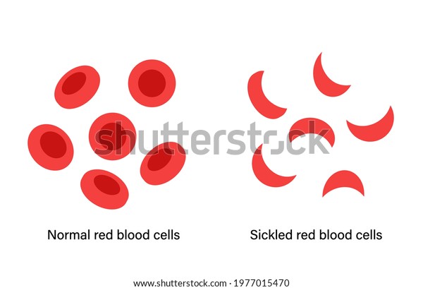 Comparison Normal Blood Sickle Cells Anemia Stock Vector (Royalty Free ...