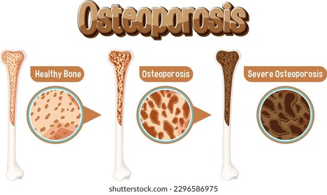 Comparison of normal bone and bone with Osteoporosis illustration