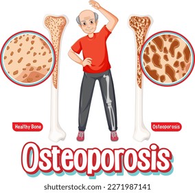 Comparison of normal bone and bone with Osteoporosis in old people illustration