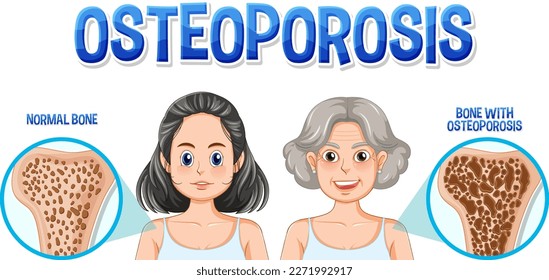 Comparison of normal bone and bone with Osteoporosis in old people illustration