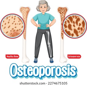 Vergleich von Knochen und Knochen mit Osteoporose bei älteren Menschen, Abbildung