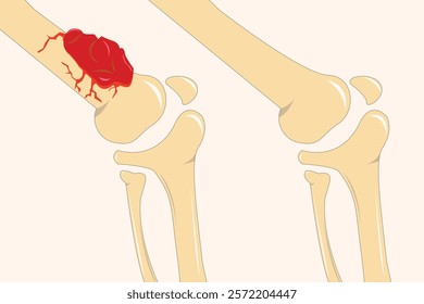 Comparison of normal bone structure and osteosarcoma-affected bone with abnormal growth. eps 10

