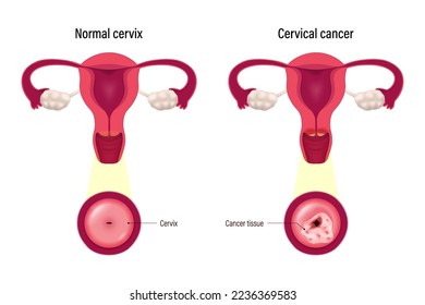 Comparison of normal cervix and cervical cancer. Cervix carcinoma. Female reproductive system disease.
