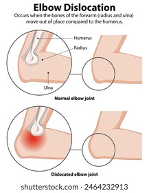 Comparison of normal and dislocated elbow joints