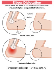 Comparison of normal and dislocated elbow joints