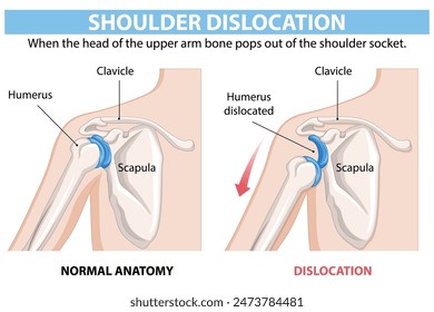 Comparison of normal and dislocated shoulder anatomy