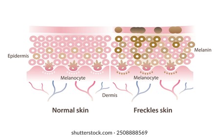 Comparação da ilustração do vetor de pele normal e sardas isolado no fundo branco. Seção transversal de camada de pele saudável e melanócitos fazem mais melanina que se desenvolvem para pequenas manchas planas marrons.