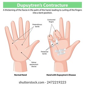 Comparison of normal hand and affected hand