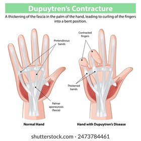 Comparison of normal hand and affected hand