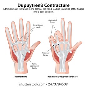 Vergleich von normaler Hand und betroffener Hand