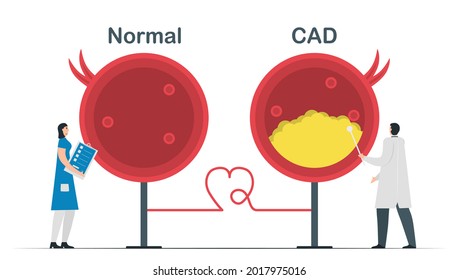 Comparison of Normal heart and Coronary artery disease.Cardiology vector illustration isolated on white background.
