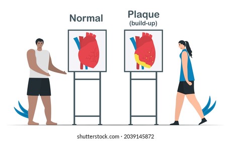 Comparación de cardiopatía normal y enfermedad arterial coronaria. La formación de plaquetas puede crear depósitos de colesterol en la arteria. Ilustración vectorial de cardiología aislada en fondo blanco.