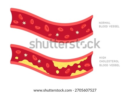 Comparison of normal and high cholesterol blood vessels. LDL cholesterol. Concept of health care, medicine, medical checkup, atherosclerosis. Flat vector illustration.