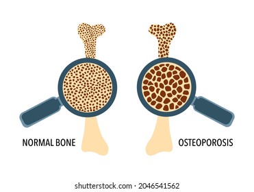 Comparison Of Normal Human Bone With Osteoporosis Infographic Concept Vector Illustration On White Background. 
