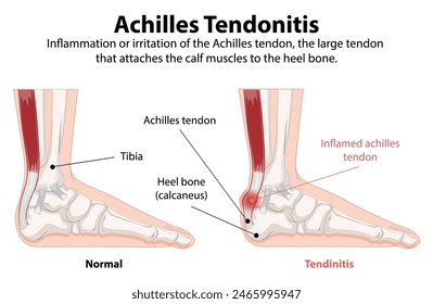 Comparison of normal and inflamed Achilles tendon