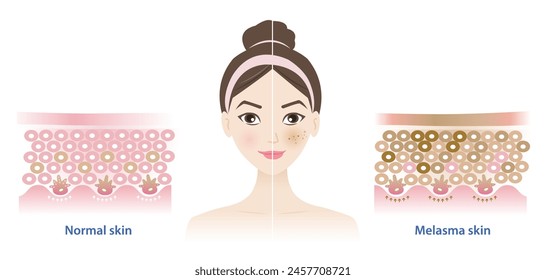 Comparison of normal and melasma skin on woman face vector illustration on white background. Diagram of healthy epidermis skin layer, melasma and dark spots. Skin care and beauty concept.