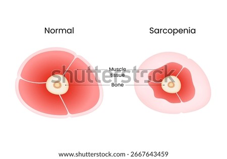 Comparison of Normal Muscle and Sarcopenia in Cross Section