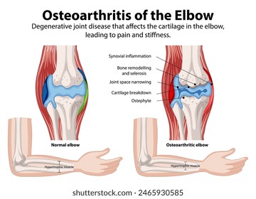 Comparison of normal and osteoarthritic elbow joints
