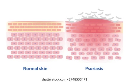 Comparison of normal and psoriasis skin vector illustration. Cross section of healthy skin barrier and psoriasis that leads to thick plaques, silvery scales, inflammation, redness and irritation.