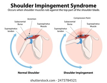 Comparison of normal shoulder and impingement