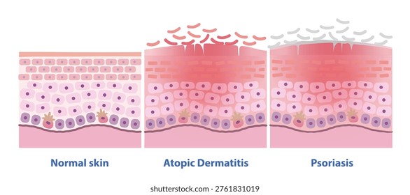 Comparison of normal skin, Atopic Dermatitis and Psoriasis vector illustration. Cross section of Eczema, itchy, red, inflamed, leading to dry, scaly. Psoriasis plaques are thick, silvery scales.