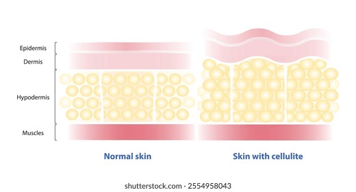 Comparison of normal skin and skin with cellulite vector illustration isolated on white background. The fat cells enlarged, connective tissue stretched. The skin dimpling, looks like orange peel.