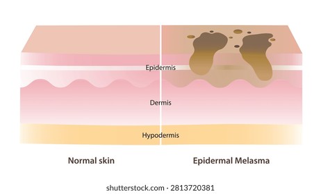 Comparison of normal skin and Epidermal melasma on skin layer illustration. Cross section of Epidermal melasma, affects the epidermis and appears as dark brown patches. Facial skin problem concept.
