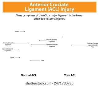 Comparación de LCA normal y desgarrado en la rodilla