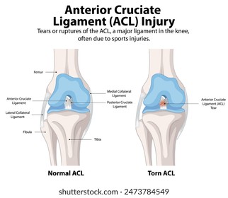 Comparación de LCA normal y desgarrado en rodilla