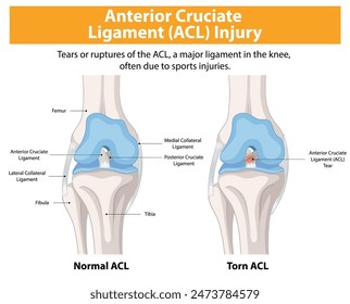 Comparison of normal and torn ACL in the knee