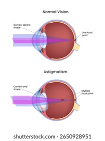 Comparação da visão normal e do astigmatismo no olho humano