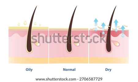 Comparison of oily, normal and dry skin vector illustration. Cross section of oily skin overproduction of sebum, normal skin keep moisturize, prevent water loss and lack of sebum in dry skin.