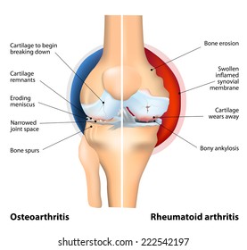 progresszív osteoarthritis)