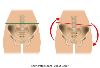 Comparison of pelvic distortion. Normal pelvis and distorted pelvis. A Twisted Pelvis, also called Pelvic Torsion