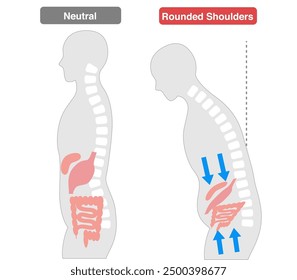Comparison of people whose internal organs are compressed due to poor posture caused by a Rounded Shoulders.