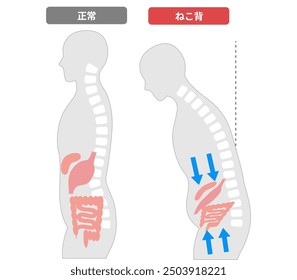 Comparison of people whose internal organs are compressed due to poor posture caused by a Rounded Shoulders. [Translate]Rounded Shoulders posture, correct posture