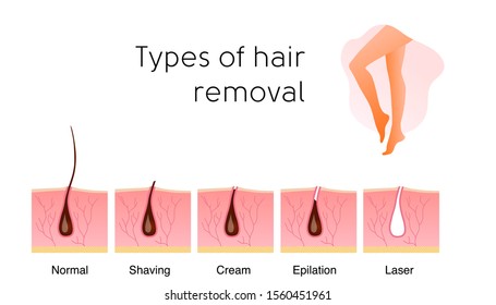Comparison Popular Methods Hair Removal Shaving Stock Vector (Royalty Free)  1560451961 | Shutterstock