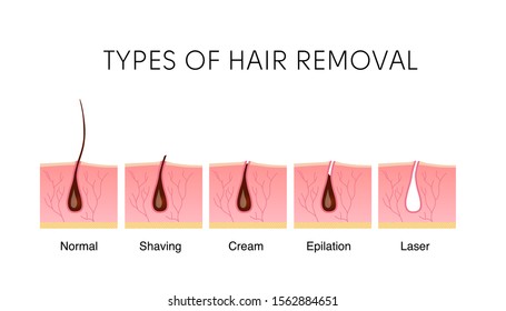 Comparison of the popular methods of hair removal: shaving, cream, epilator, and laser. Anatomy infographics vector illustration.