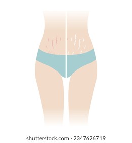 Comparison of red and white stretch marks on tummy vector illustration isolated on white background. The striae rubrae and striae albae appear on the abdomen, mid stomach, belly front of woman body.