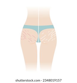 Comparison of red and white stretch marks on buttocks vector illustration isolated on white background. The striae rubrae and striae albae appear on the bottom, hip, ass back of woman body.