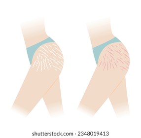 Comparison of red and white stretch marks on hip and thigh vector illustration isolated on white background. The striae rubrae and striae albae appear on the hip and thigh side of woman body.