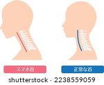 Comparison of smartphone neck and normal neck

In Japanese, it says "smartphone neck" and "normal cervical spine"