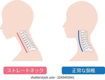 Comparison of straight neck and normal neck

There is a description in Japanese of "straight neck" and "normal cervical spine"