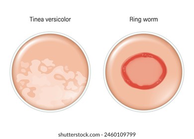 Comparison of Tinea versicolor and Ring worm. Dermatology. Dermatophytosis skin with fungal infection.