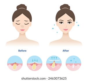 Comparison of woman face before and after blackhead removal vector illustration isolated on white background. Icon set of blackhead treatment process, apply, peel off, unclogging and tighten pore.