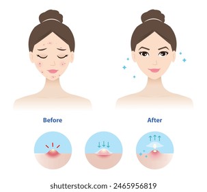 Comparación de la cara de la mujer antes y después de usar el parche de grano de acné para la Ilustración vectorial del acné inflamatorio sobre fondo blanco. Conjunto de iconos de dirección para el uso de parche de acné pústula absorbente en la cara de la piel.