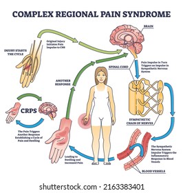 Complex regional pain syndrome or CRPS as painful condition outline diagram. Labeled educational arm or leg swelling cycle with body response vector illustration. Sympathetic nervous system impulse.