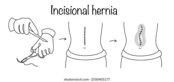 Uma complicação da cirurgia que se manifesta no período de recuperação precoce ou tardia. Processo desenhado do aparecimento de uma hérnia no abdômen. Vetor isolado médico sobre fundo branco.